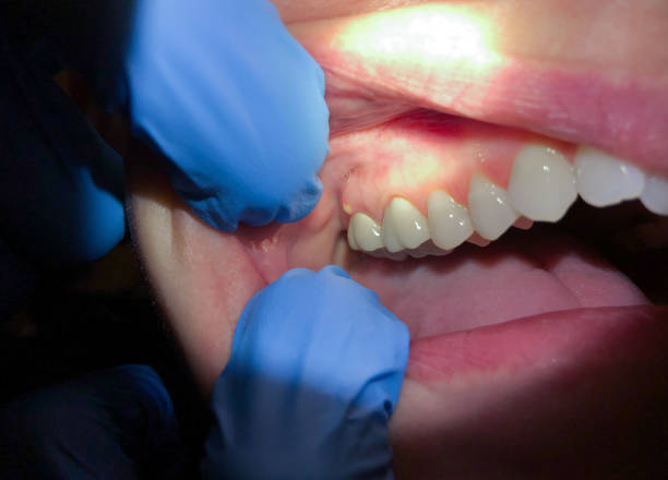 Best Knocked-Out Tooth (Avulsed Tooth) Treatment in Orinda, CA